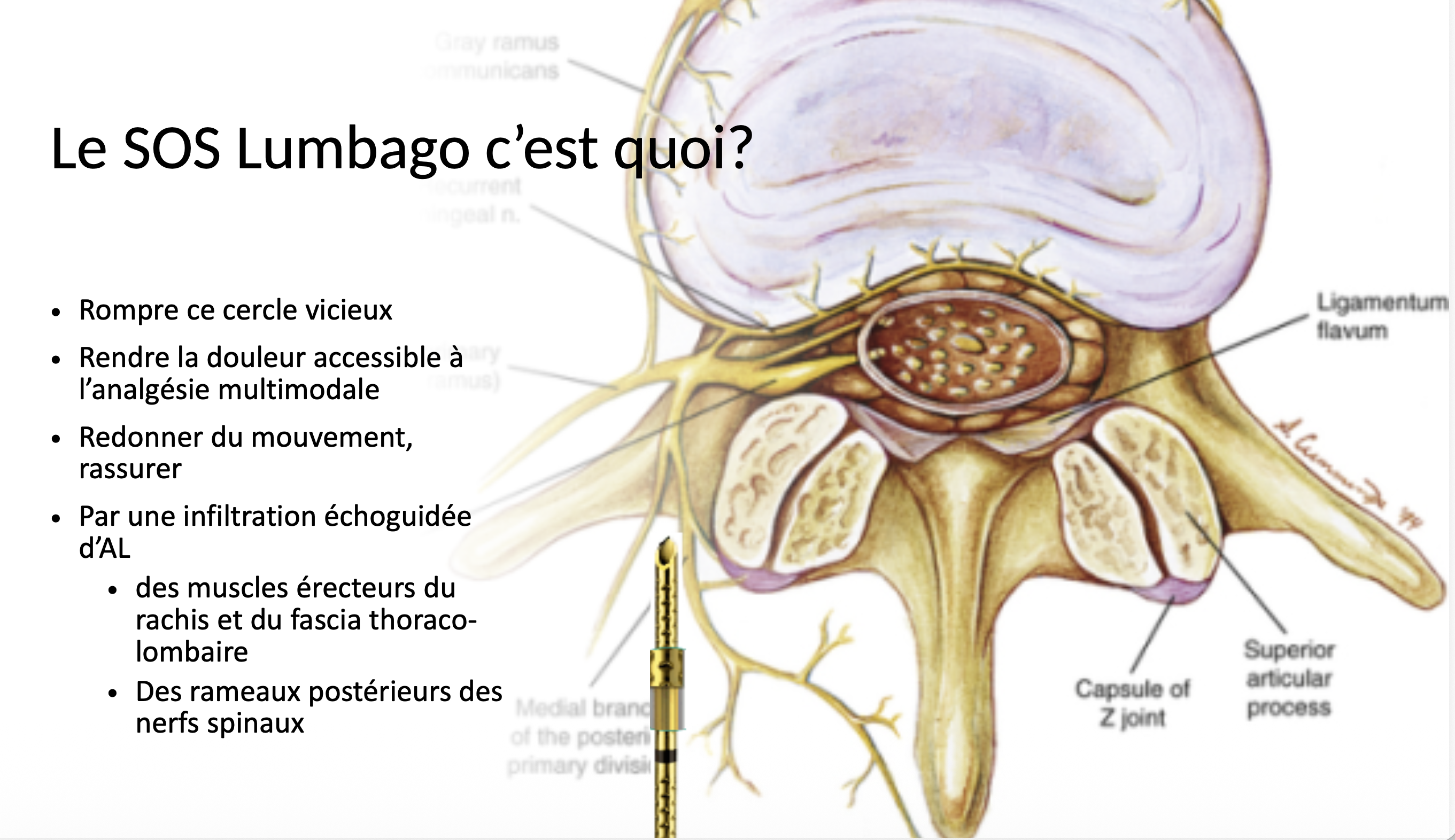 Miniature de Technique d'infiltration